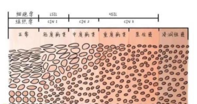 HPV感染的症状？